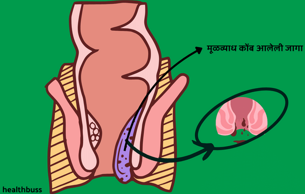 mulvyadh ayurvedic upaay2